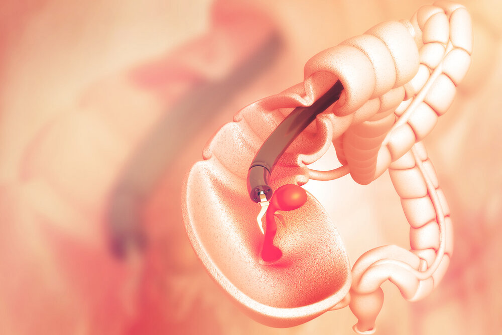 You are currently viewing What You Need To Know About Colonoscopy And Colorectal Cancer